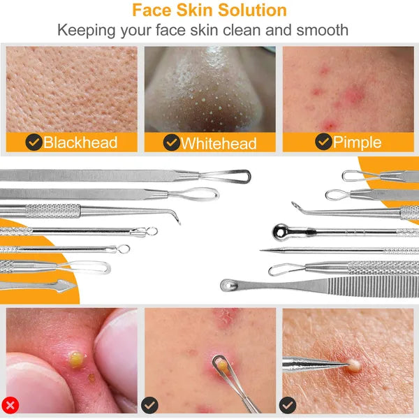 7-Piece Stainless Steel Blackhead Remover Kit — Pimple Comedone Acne Extractor Needle Tools